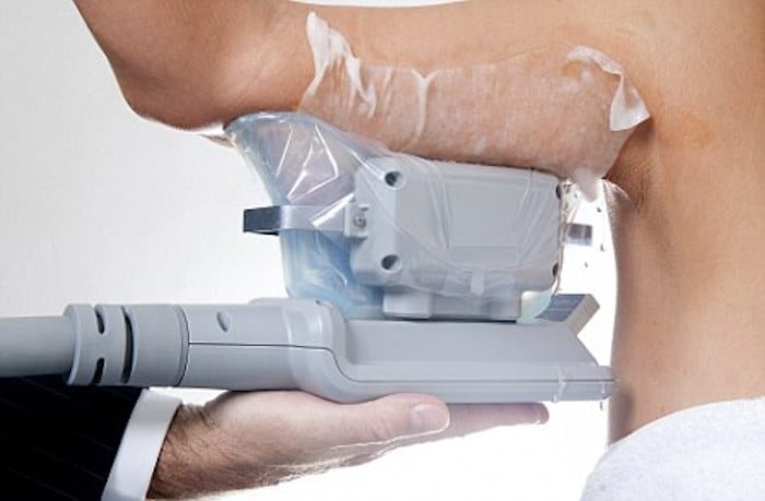 fat freezing arms Canary Wharf