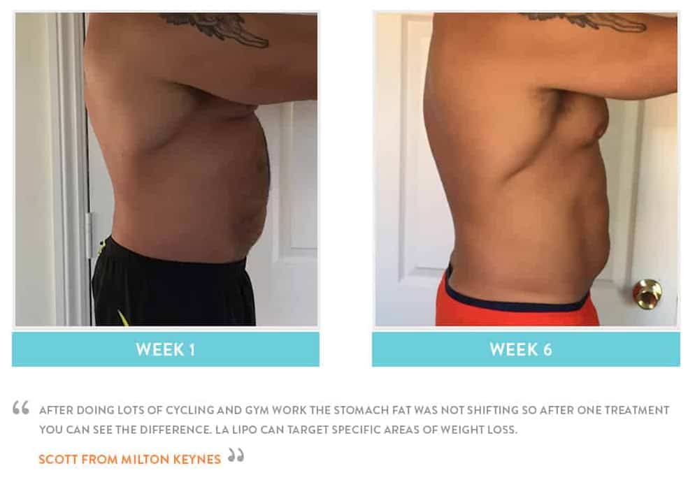 Before & After Stomach Fat Canary Wharf