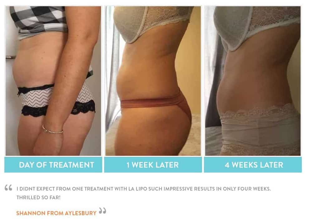 before, Cryolipolysis Canary Wharf