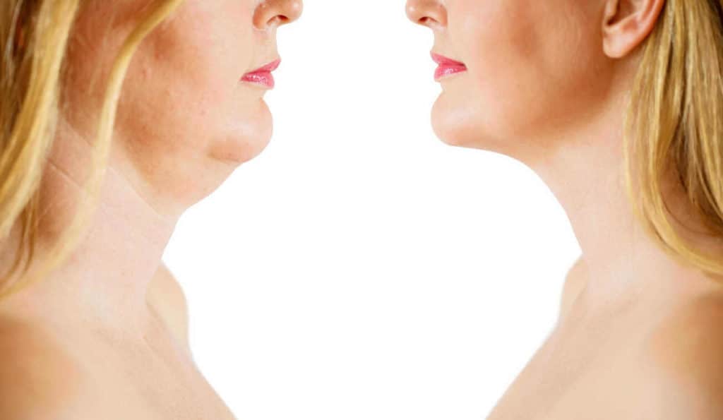 Double Chin treatment Canary Wharf before and after results