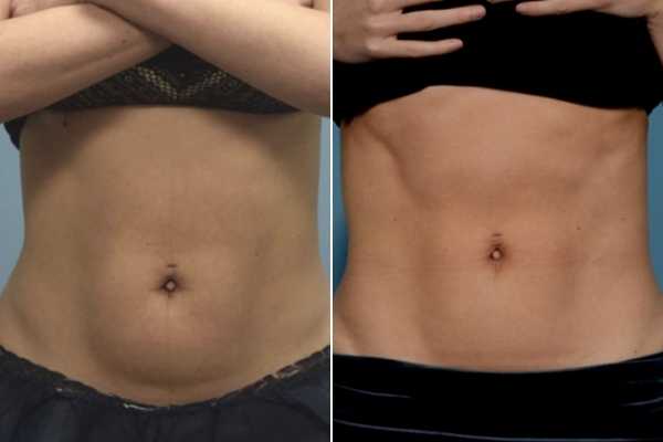 body sculpting FAQs Canary Wharf