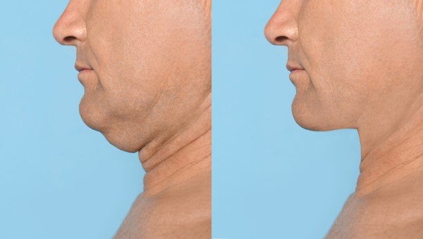 Which Non-Surgical Treatments Work Best for Jowls and Loose Skin Canary Wharf?