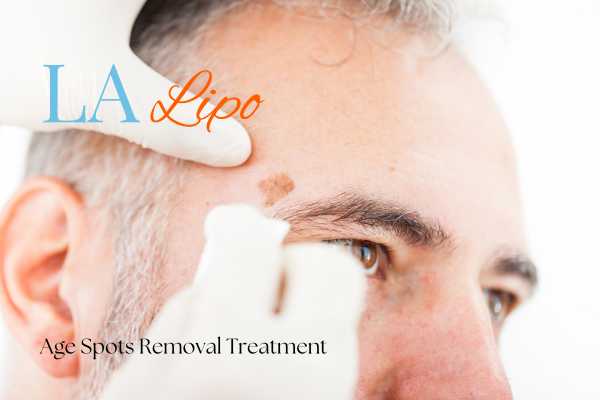 What Are the Most Effective Treatments for Age Spots Canary Wharf?