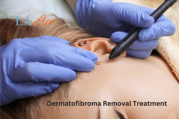 Dermatofibroma Removal Treatment Canary Wharf