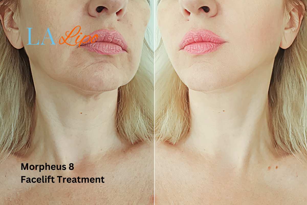 Turn back time with Morpheus8 Treatment Canary Wharf