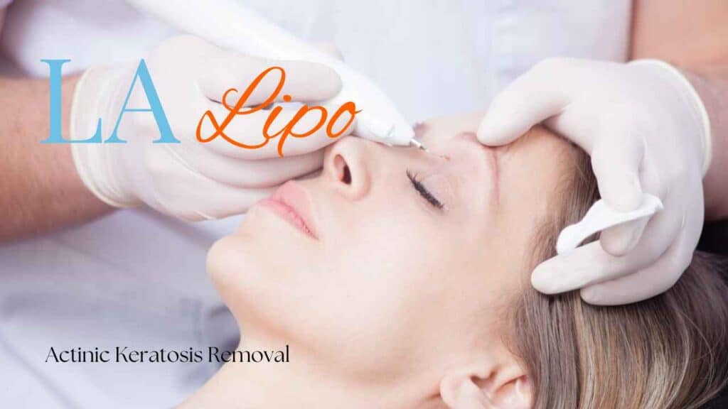 actinic keratosis removal Canary Wharf