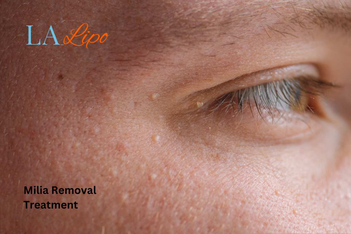 Cryopen Milia Removal: Is It the Easiest and Safest Option Canary Wharf?