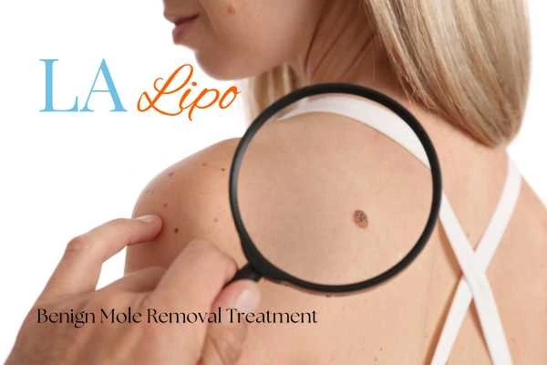 Why getting moles removed Canary Wharf can boost your confidence!