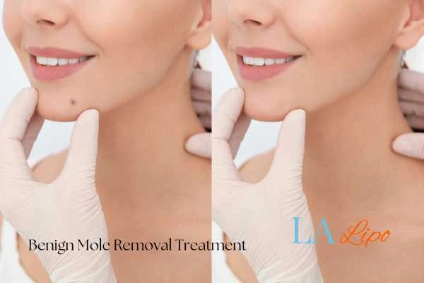 Woman's before and after results of being moles removal treatment Canary Wharf