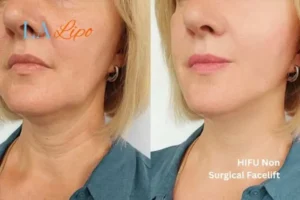 hi-fu for wrinkles Canary Wharf before and after results