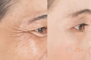 Before and after results of woman - HI-fu wrinkles reduction treatment Canary Wharf