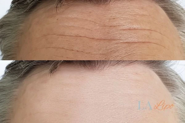 results of HIFU Canary Wharf on mans forehead to help reduce lines and wrinkles