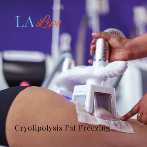 fat freezing - Cryolipolysis Canary Wharf