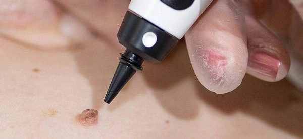 skin tag removal using cryopen Canary Wharf