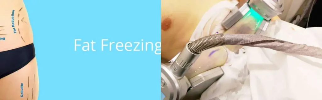 multi areas of a persons body having coolsculpting Canary Wharf treatment