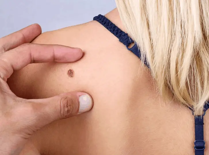 woman having mole removal Canary Wharf consultation before treatment.