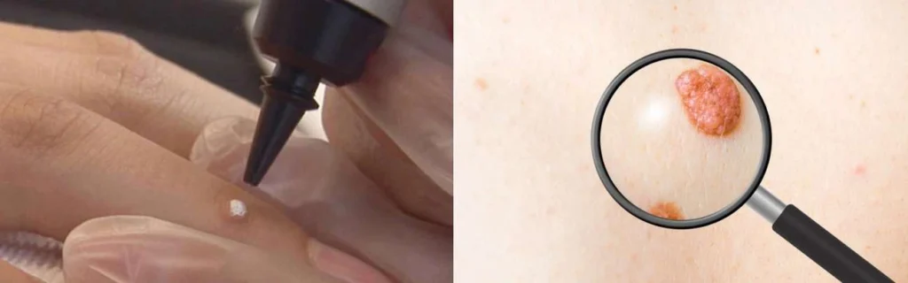 Person getting moles removed with cryopen Canary Wharf