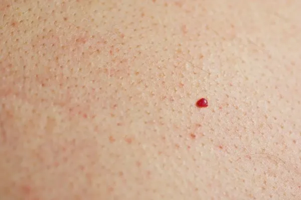 close up of a cherry angioma Canary Wharf