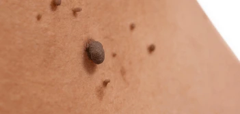 image of a skin tag Canary Wharf