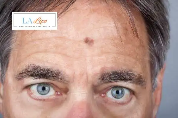 Solar Lentigo Removal Canary Wharf image of man with mark on his forehead