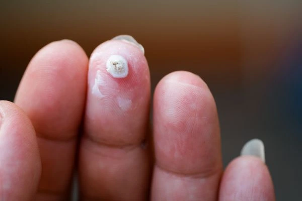 wart on person finger - cryotherapy to treat from LA LIPO Canary Wharf