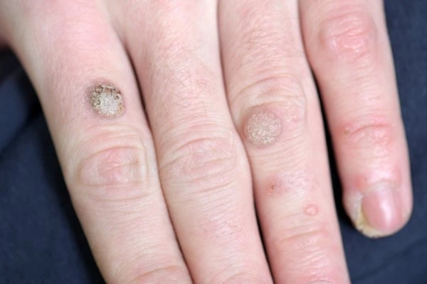 photo of warts on person hand - see wart removal Canary Wharf from LA LIPO