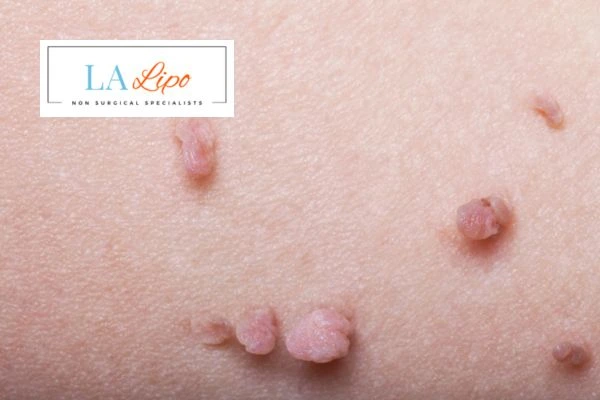 Does cryopen skin tag removal Canary Wharf hurt? Find out now call our team today!