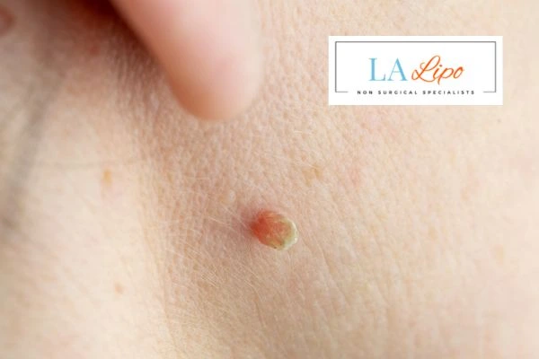 Book skin tag removal Canary Wharf today speak to our team now!