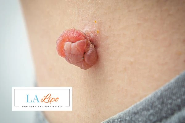 Interested in skin tag removal Canary Wharf? Concerned about the pain? Find out more today!