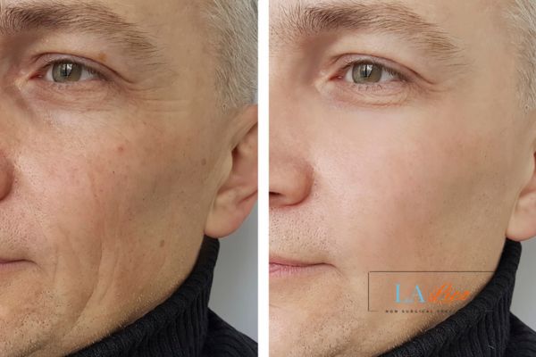 See the amazing results of Morpheus8 Treatment Canary Wharf!