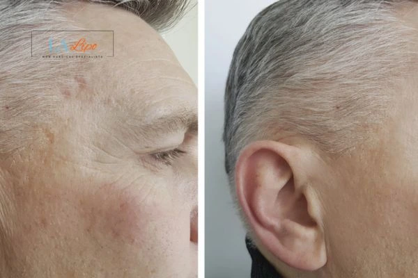 Mens Before & After Morpheus 8 Results Canary Wharf