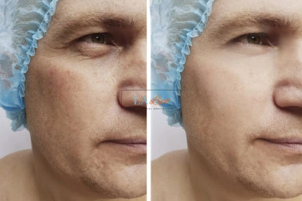 Before and after Morpheus 8 Results Canary Wharf