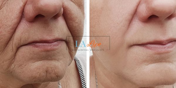 Older lady deeper wrinkle reduction - LA LIPO Morpheus 8 Results Canary Wharf