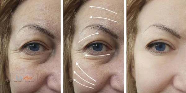 Amazing eye lift Morpheus 8 results Canary Wharf
