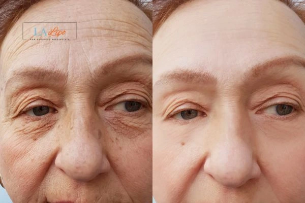 The powerful benefits of Morpheus8 Treatment Canary Wharf - Call Our team today!
