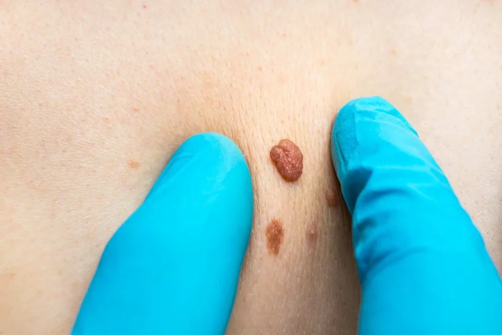 LA LIPO Cryopen Lesion Removal Prices Canary Wharf