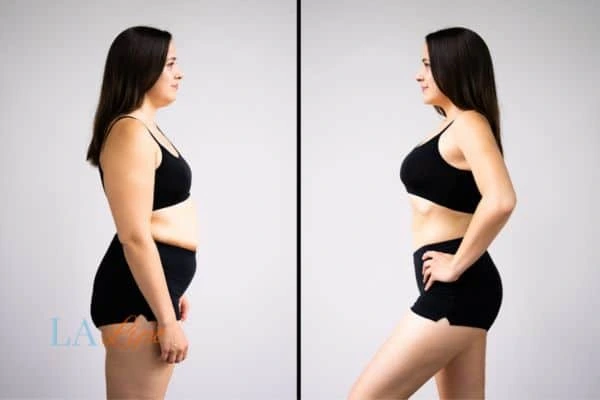 Picture of womans before and after using LA-EMS body sculpting to improve her core strength Canary Wharf