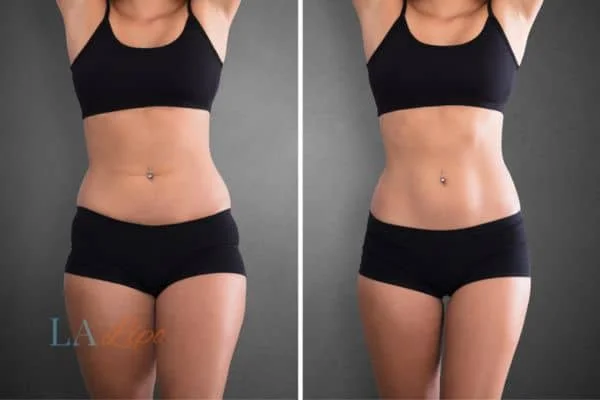 before and after results of non-surgical treatment to help a woman's body image and mental health Canary Wharf