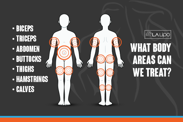 Diagram to show areas you can have LA-EMS Body Sculpting Treatment Canary Wharf
