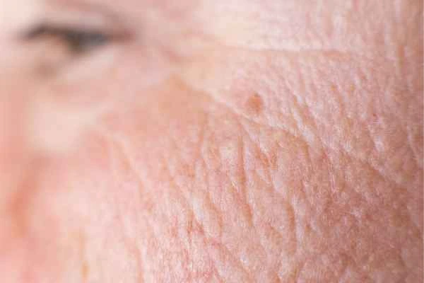 close up picture of a woman's face showing an age spot Canary Wharf