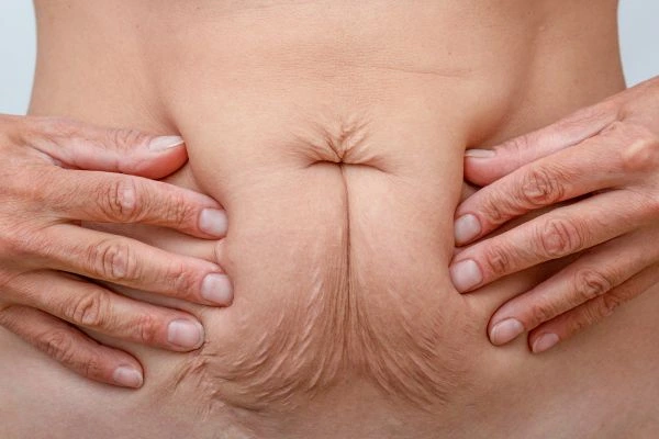 Image of a woman's stomach with loose skin - example of skin tightening Canary Wharf options