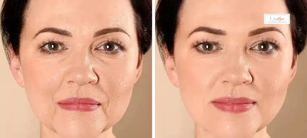 How Long Does It Take to See Results and How Long Do They Last Canary Wharf?