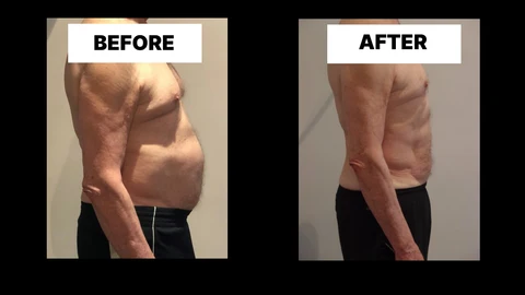 What Symptoms Can Diastasis Recti Cause in Men? Weak Core, Back Pain and Poor Posture Canary Wharf